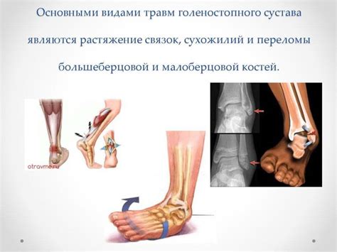Результаты лечения разрыва связок