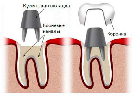 Риски стачивания коронки и как их уменьшить