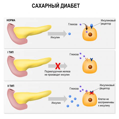 Сахарный диабет и папилломы: связь и проблемы
