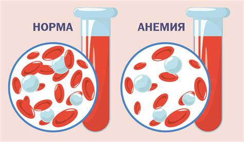 Связь железодефицитной анемии и веса