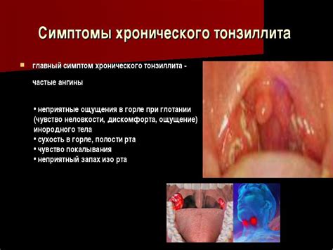 Симптомы хронического тонзиллита