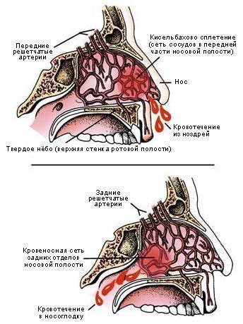 Сухость слизистой оболочки носа как фактор кровотечений