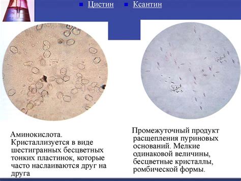 Физическая природа осадка в моче