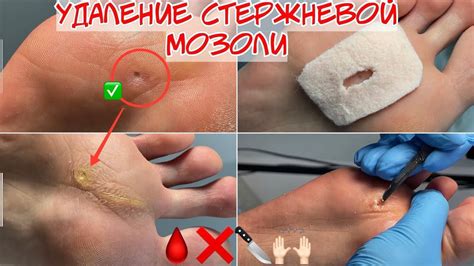 Хирургическое удаление стержневой мозоли
