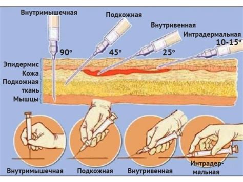 Шаг 3: Правильное содержание иглы