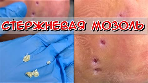 Электрокоагуляция стержневой мозоли