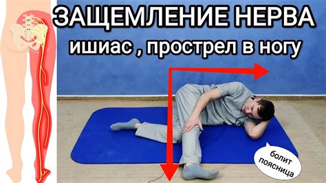Эффективность иглоукалывания при защемлении седалищного нерва