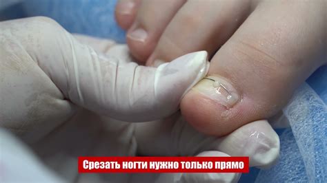 Эффективный метод удаления нерва: безболезненное лечение