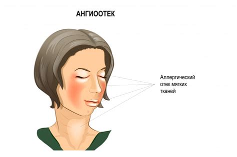  Сопутствующие рекомендации при отеке квинке 